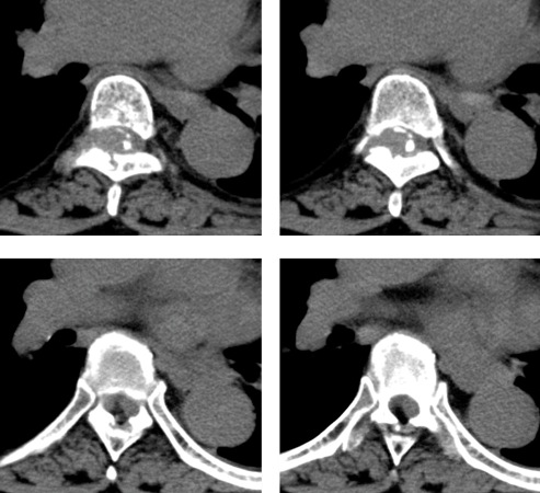 Figure 2 for case Chondrosarcoma ( RID4140 ) of the vertebral column